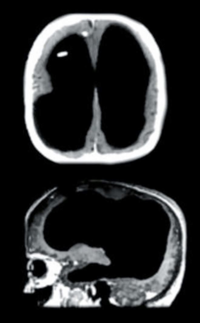 hidrocefalia